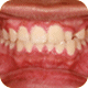 Gum Disease (Gingivitis)